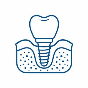 Implantes Dentários