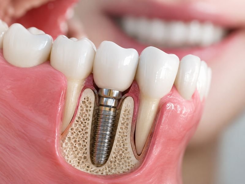 Implante dentário Jaguaré: paciente sorrindo após reabilitação na Lucmoura